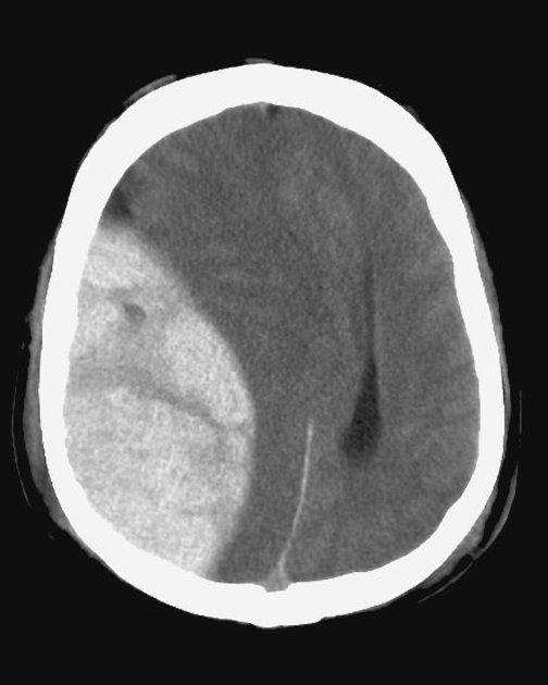04.11 [04.02 Patologie Neuroradiologiche] Emorragia Epidurale